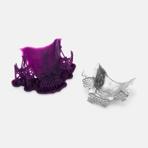 脱蜡铸造可摘局部义齿 (RPD)